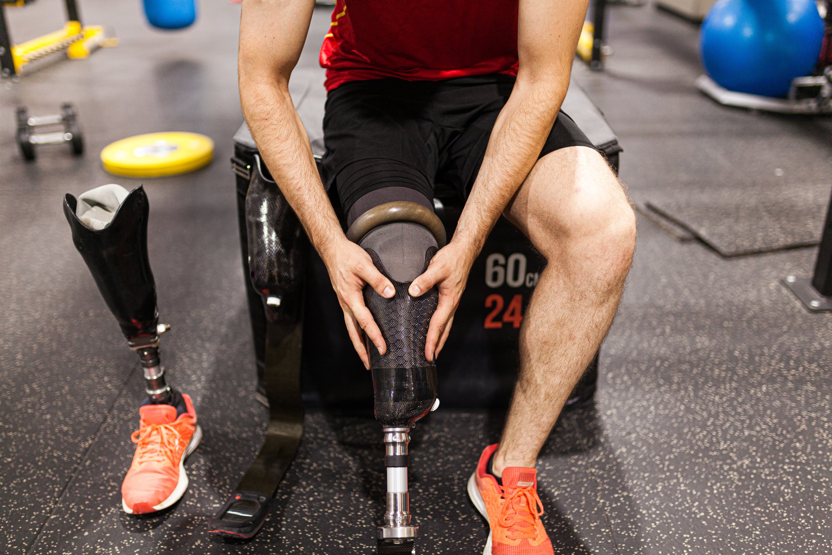 AbovetheKnee Leg Amputations Here's What to Expect