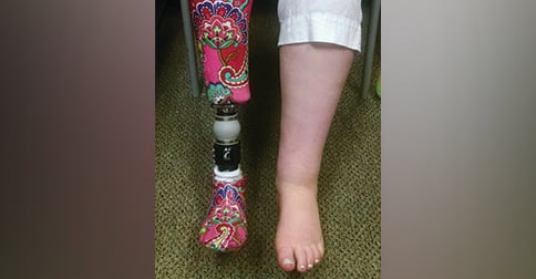 help kids understand limb loss