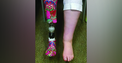 Books to Help Children Understand Limb Loss